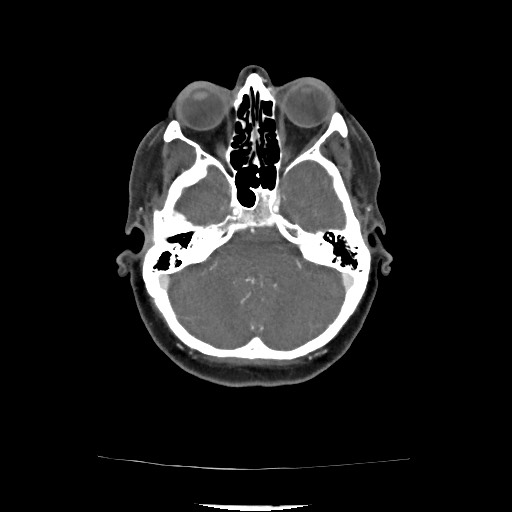 File:Acute subarachnoid hemorrhage and accessory anterior cerebral artery (Radiopaedia 69231-79009 Axial C+ arterial phase 84).jpg