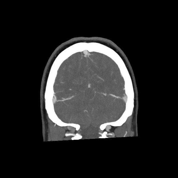Acute subarachnoid hemorrhage and accessory anterior cerebral artery (Radiopaedia 69231-79009 Coronal C+ arterial phase 66).jpg