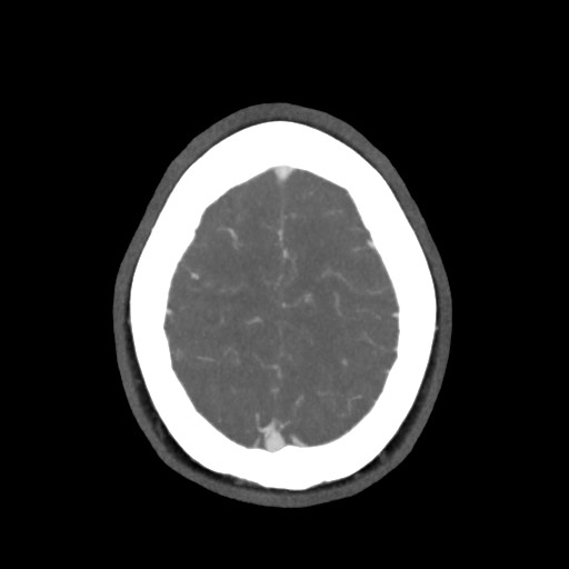 Acute subarachnoid hemorrhage and accessory anterior cerebral artery (Radiopaedia 69231-79009 D 59).jpg