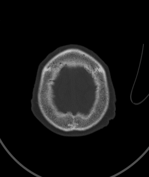 Acute traumatic subdural hematoma (Radiopaedia 82921-97257 Axial bone window 17).jpg