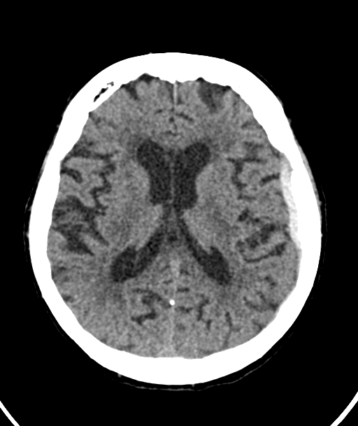 Acute traumatic subdural hematoma (Radiopaedia 82921-97257 Axial non-contrast 31).jpg