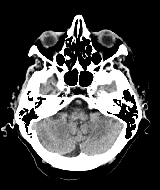 Acute traumatic subdural hematoma (Radiopaedia 82921-97257 Axial non-contrast 50).jpg