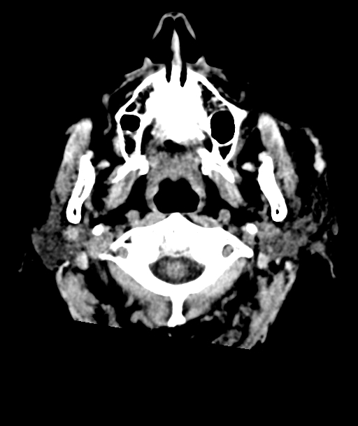 Acute traumatic subdural hematoma (Radiopaedia 82921-97257 Axial non-contrast 63).jpg