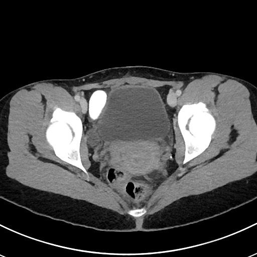 Acute uncomplicated appendicitis (Radiopaedia 61374-69304 Axial C+ portal venous phase 119).jpg