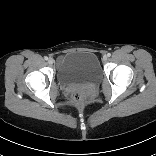 Acute uncomplicated appendicitis (Radiopaedia 61374-69304 Axial C+ portal venous phase 123).jpg
