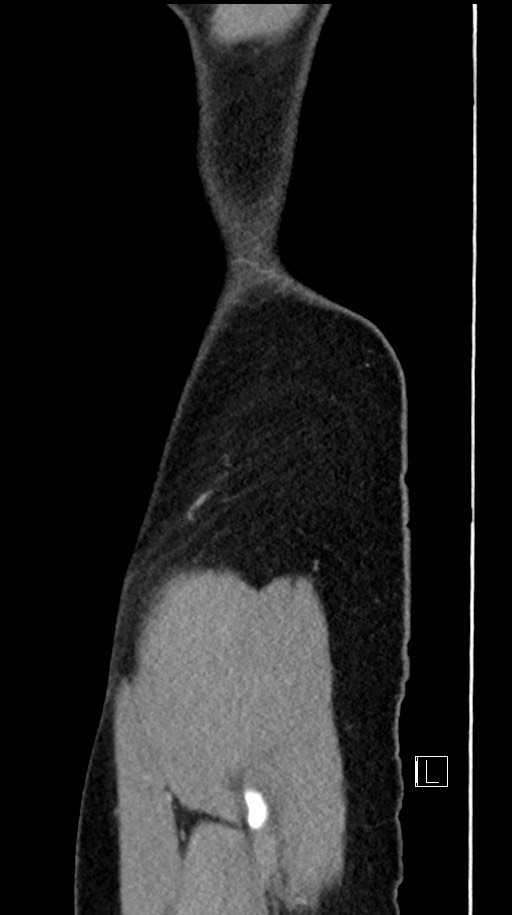 Acute uncomplicated appendicitis (Radiopaedia 61374-69304 Sagittal C+ portal venous phase 100).jpg