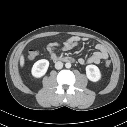 Acute uncomplicated appendicitis (Radiopaedia 88350-104982 Axial C+ portal venous phase 39).png