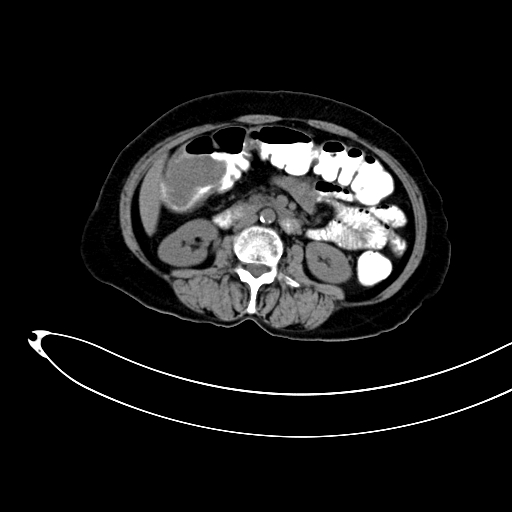 Adenocarcinoma colon with intussusception (Radiopaedia 86006-101922 Axial non-contrast 24).jpg