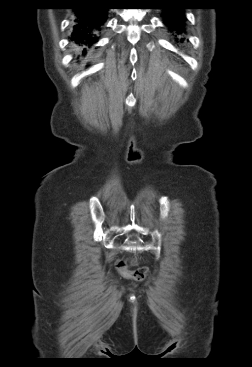 Adenocarcinoma of cecum (Radiopaedia 59222-66549 Coronal C+ portal venous phase 66).jpg