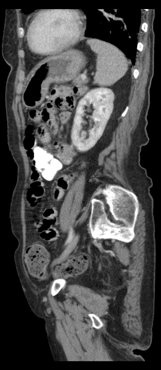 Adenocarcinoma of cecum (Radiopaedia 59222-66549 Sagittal C+ portal venous phase 23).jpg