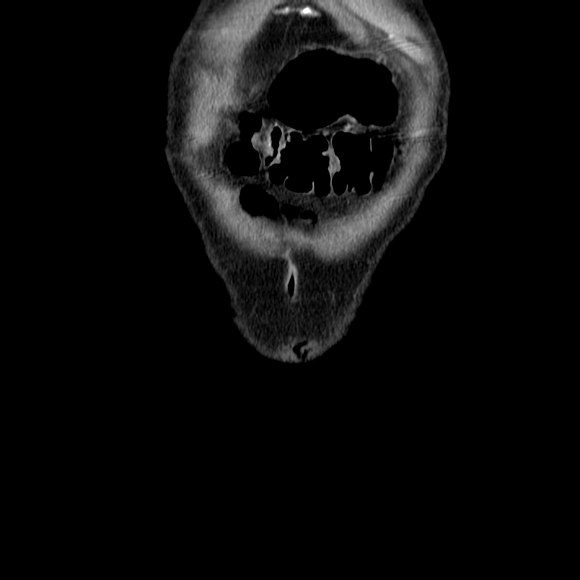 Adenocarcinoma of colon with entero-colic fistula (Radiopaedia 22832-22852 Coronal C+ portal venous phase 5).jpg
