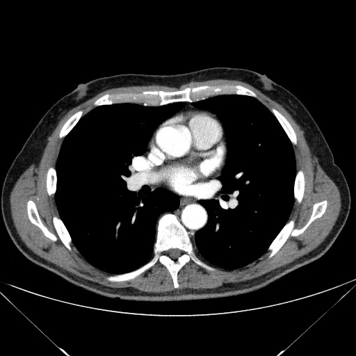 Adenocarcinoma of the lung (Radiopaedia 59871-67325 Axial C+ arterial phase 48).jpg