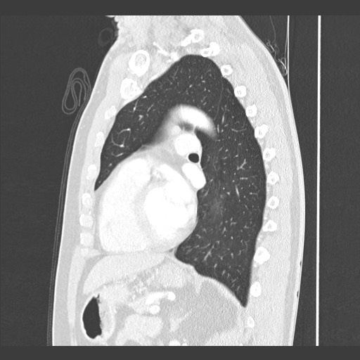 Adenocarcinoma of the lung (Radiopaedia 59871-67325 Sagittal lung window 63).jpg
