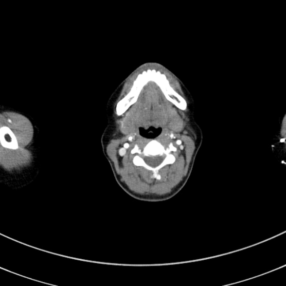 File:Adenocystic carcinoma of the trachea (Radiopaedia 47677-52525 Axial C+ arterial phase 14).jpg