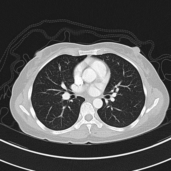 Adenocystic carcinoma of the trachea (Radiopaedia 47677-52525 Axial lung window 53).jpg