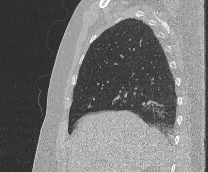 File:Adenoid cystic carcinoma of the trachea (Radiopaedia 49042-54137 Sagittal lung window 126).jpg