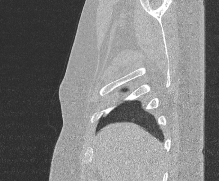 Adenoid cystic carcinoma of the trachea (Radiopaedia 49042-54137 Sagittal lung window 47).jpg