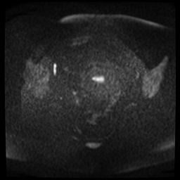 File:Adenomyosis-scar endometriosis (Radiopaedia 65863-75022 Axial DWI 9).jpg