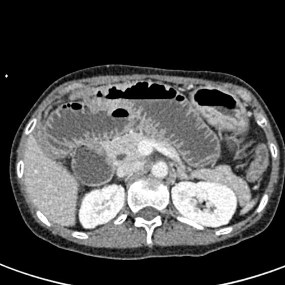 File:Adhesional small bowel obstruction (Radiopaedia 48397-53305 Axial C+ portal venous phase 21).jpg