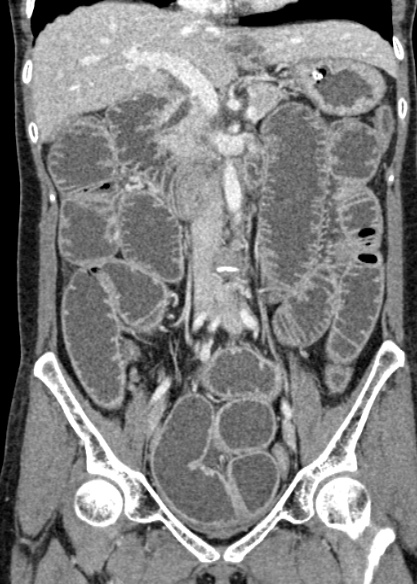 Adhesional small bowel obstruction (Radiopaedia 48397-53305 Coronal C+ portal venous phase 167).jpg