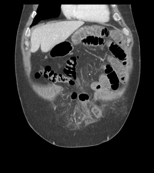 File:Adhesions within abdominal wall hernia (Radiopaedia 58283-65394 Coronal C+ portal venous phase 19).png