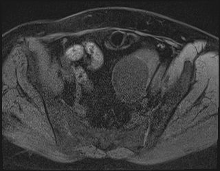 File:Adnexal multilocular cyst (O-RADS US 3. O-RADS MRI 3) (Radiopaedia 87426-103754 Axial 195).jpeg