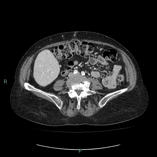 File:Adrenal collision tumor (ACT) (Radiopaedia 48462-53379 Axial C+ portal venous phase 36).jpg