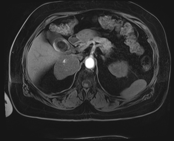 File:Adrenal cortical carcinoma (Radiopaedia 64017-72770 Axial T1 C+ fat sat 10).jpg