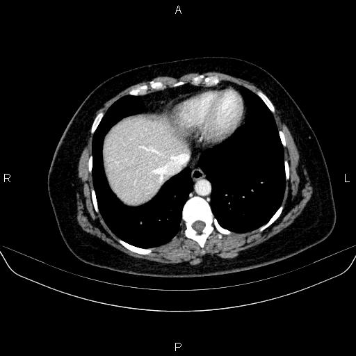 Adrenal cortical carcinoma (Radiopaedia 84882-100379 Axial C+ portal venous phase 8).jpg