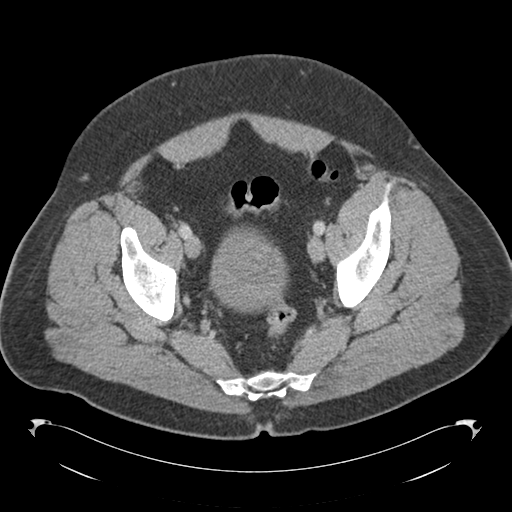 Adrenal cyst (Radiopaedia 45625-49776 Axial C+ portal venous phase 84).png