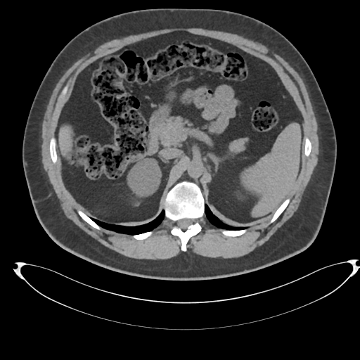 Adrenal cyst (Radiopaedia 45625-49778 Axial non-contrast 35).png