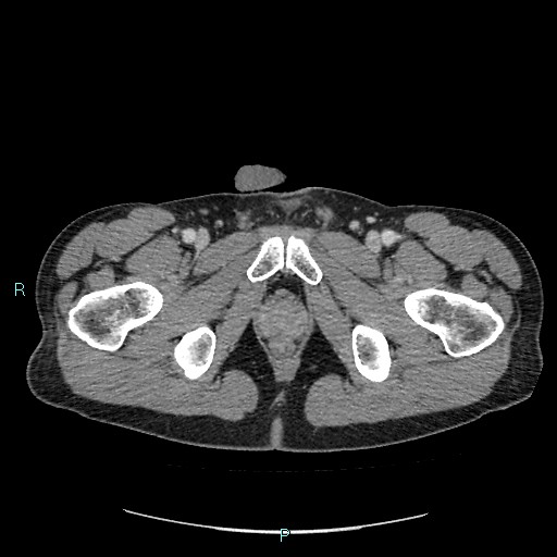 File:Adrenal cystic lymphangioma (Radiopaedia 83161-97534 Axial C+ portal venous phase 102).jpg