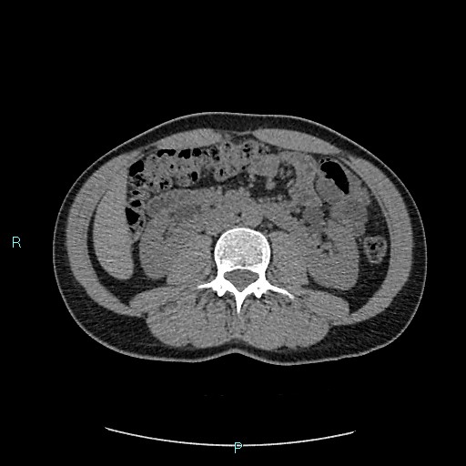 File:Adrenal cystic lymphangioma (Radiopaedia 83161-97534 Axial non-contrast 47).jpg