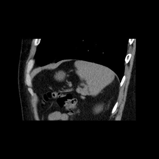 File:Adrenal gland trauma (Radiopaedia 81351-95079 Sagittal non-contrast 84).jpg