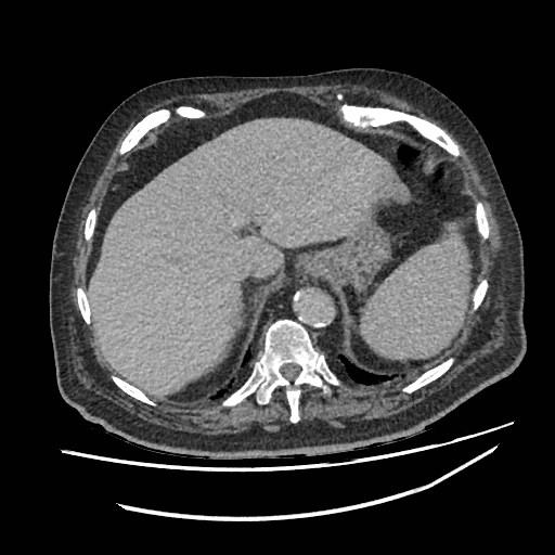 Adrenal lymphoma (Radiopaedia 84145-99415 Axial C+ portal venous phase 11).jpg