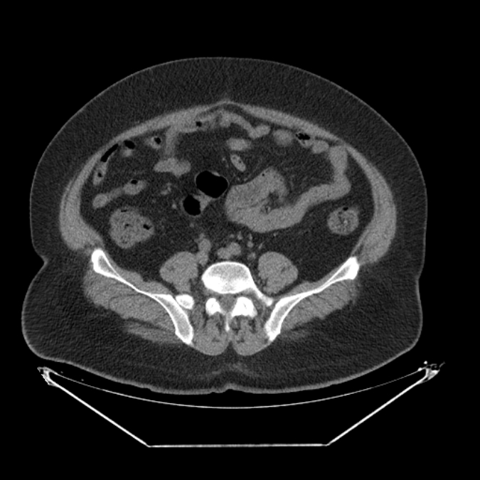 Adrenal myelolipoma (Radiopaedia 26278-26407 Axial non-contrast 49).jpg