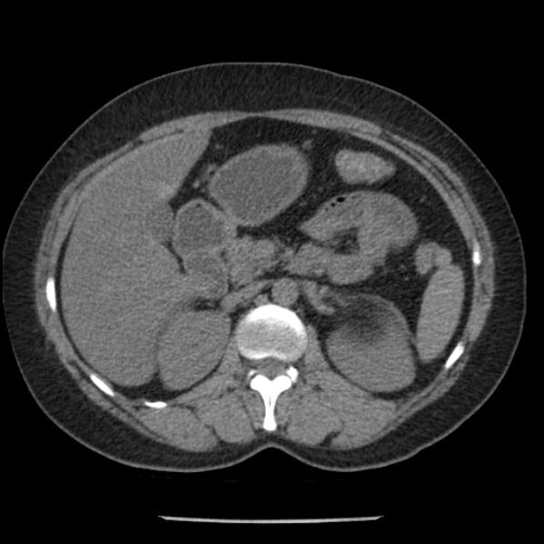 File:Adrenal myelolipoma (Radiopaedia 43401-46759 Axial non-contrast 32).jpg