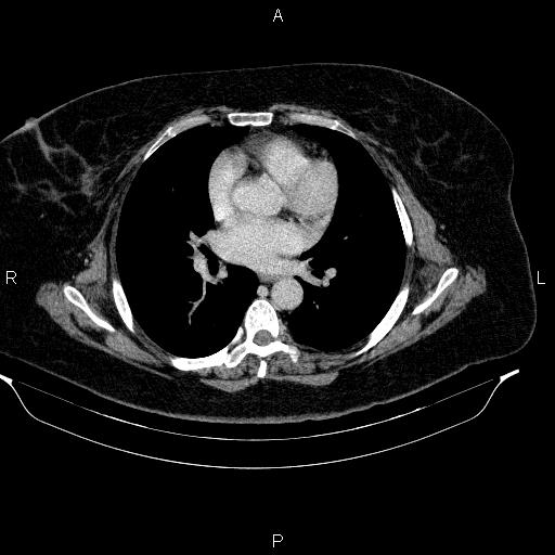 Adrenal myelolipoma (Radiopaedia 84319-99617 Axial renal cortical phase 1).jpg
