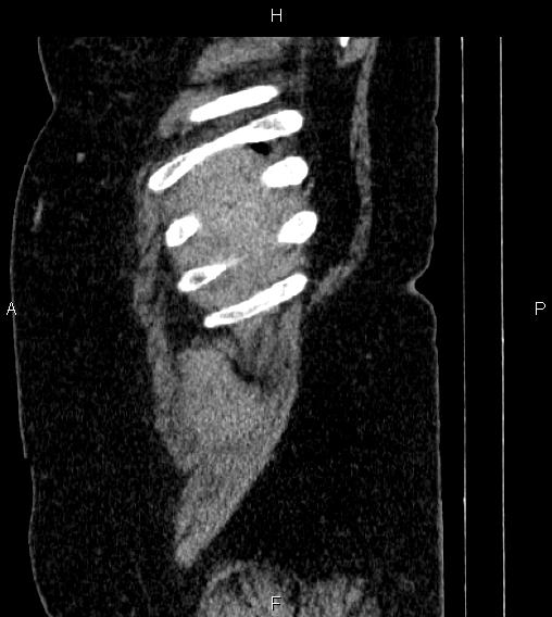 Adrenal myelolipoma (Radiopaedia 84319-99617 Sagittal renal cortical phase 3).jpg