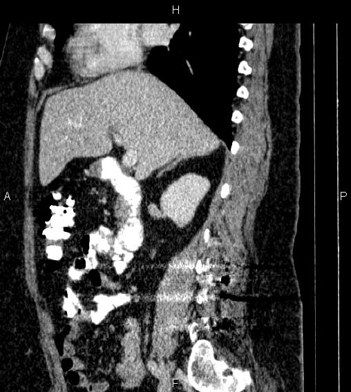 Adrenal myelolipoma (Radiopaedia 84319-99617 Sagittal renal cortical phase 36).jpg