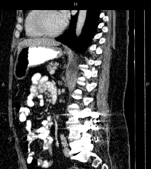 Adrenal myelolipoma (Radiopaedia 84319-99617 Sagittal renal cortical phase 56).jpg