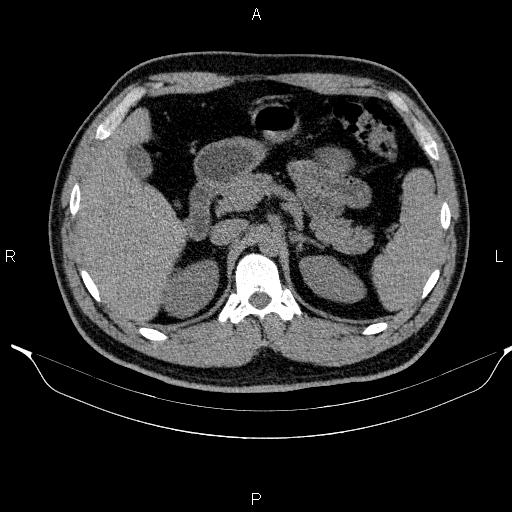 Adrenal myelolipoma (Radiopaedia 84321-99619 Axial non-contrast 36).jpg