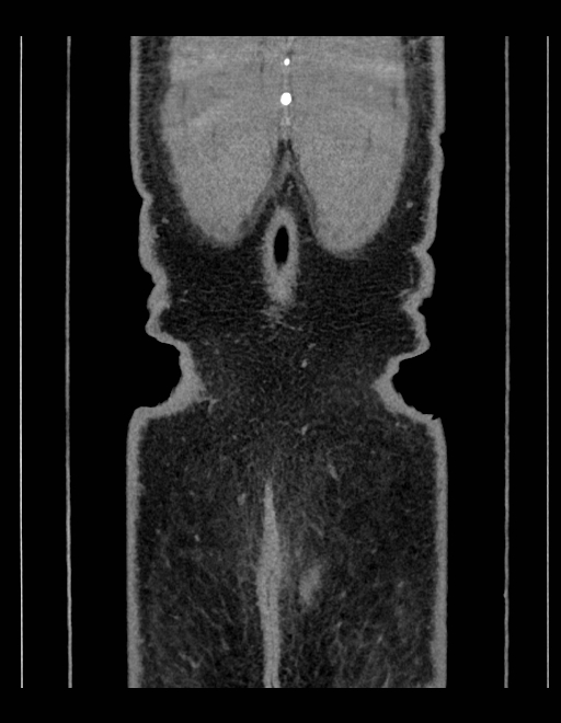 Adrenal myelolipoma - bilateral (Radiopaedia 74805-85810 Coronal C+ portal venous phase 39).jpg