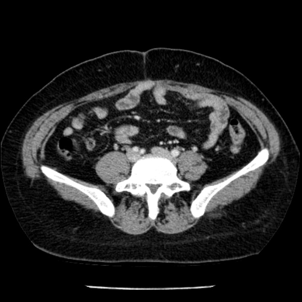 Adrenal myelolipoma and beaver tail liver (Radiopaedia 86201-102193 Axial non-contrast 148).jpg