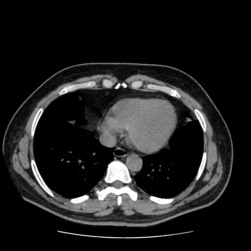 Adrenal myelolipoma and beaver tail liver (Radiopaedia 86201-102193 Axial non-contrast 3).jpg