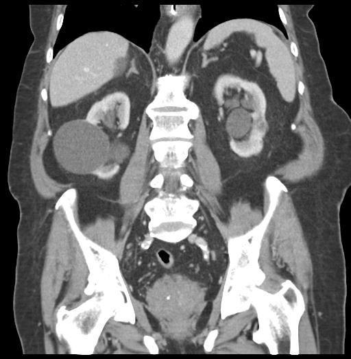 Adult ileal intussusception with secondary obstruction (Radiopaedia 30395-31051 Coronal C+ portal venous phase 41).jpg