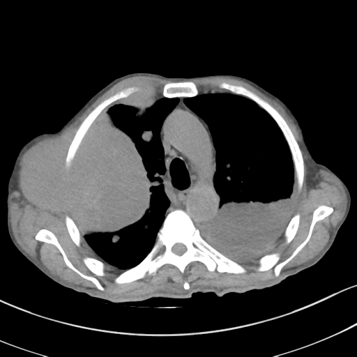 Advanced metastatic lung cancer (Radiopaedia 48910-53954 Axial non-contrast 23).png