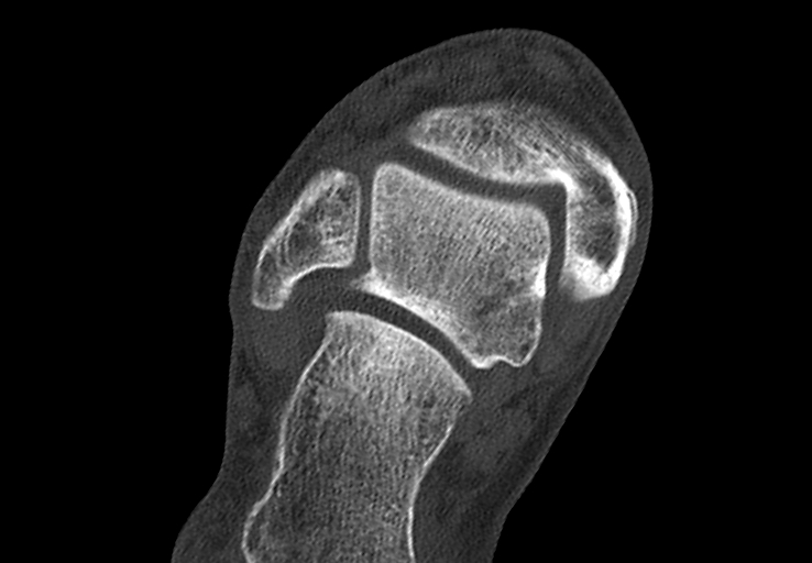 Advanced osteomyelitis due to open metatarsal fracture (Radiopaedia 83891-99095 Axial bone window 5).jpg