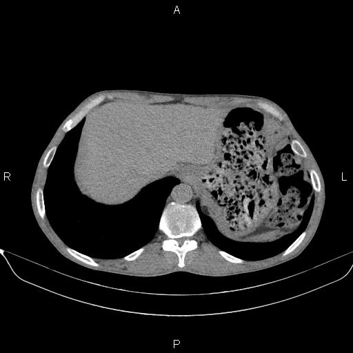 Air bronchogram in pneumonia (Radiopaedia 85719-101512 Axial non-contrast 60).jpg