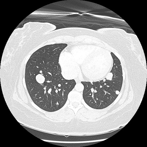 Alveolar soft part sarcoma - right leg (Radiopaedia 59432-67091 Axial lung window 78).jpg